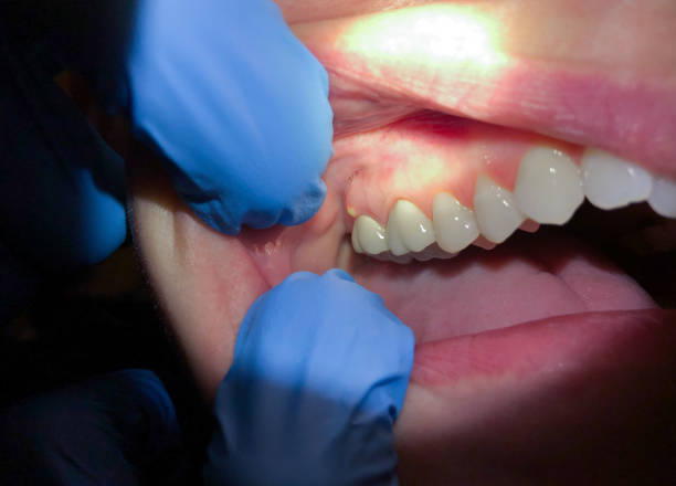Best Dental Abscess Treatment in Winter Springs, FL
